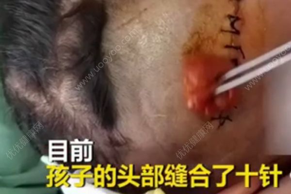 3歲男孩小區(qū)內(nèi)被狗咬頭縫10針，被狗咬傷后怎么處理？(4)