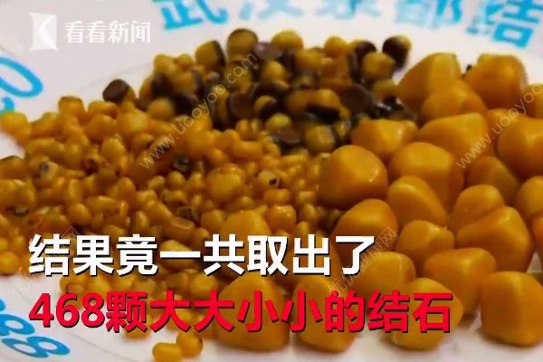 愛吃油炸長468顆結(jié)石，油炸食品的危害有哪些？(1)