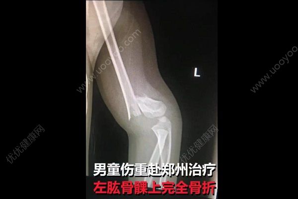 男童被踹下滑梯胳膊折成三截，肇事方家長抱娃就溜(2)