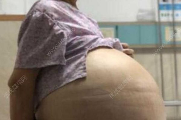 69歲大媽患婦科腫瘤肚鼓如球，醫(yī)生抽出30多升囊液(1)