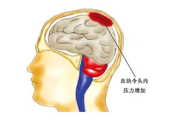 腦溢血患者家屬質(zhì)疑被過(guò)期藥加重病情，醫(yī)院:只用了一瓶(4)