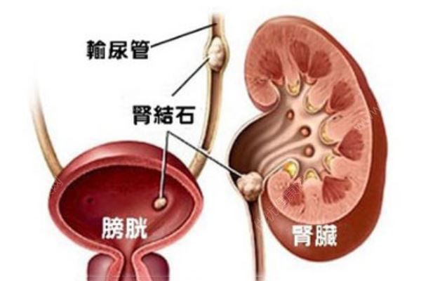 常州一大媽右腎里取出一盆結(jié)石，醫(yī)生一數(shù)，竟有2980顆(2)