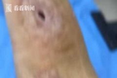 男子殺魚時不小心劃傷手指，幾個月后右手手臂被"蛀空"[多圖]