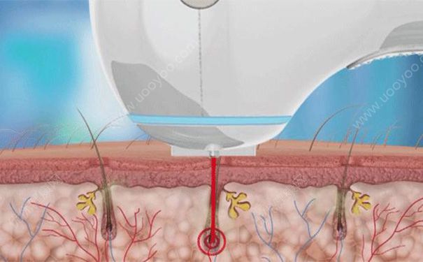 激光脫毛有副作用么？激光脫毛有什么副作用？(2)