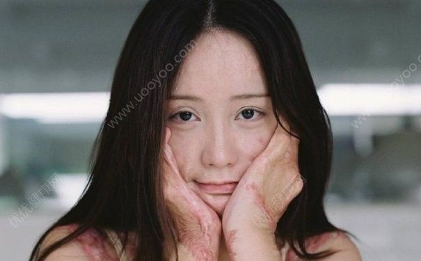 毀容少女曬寫(xiě)真 毀容后如何樂(lè)觀生活？(2)