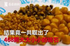 愛吃油炸長(zhǎng)468顆結(jié)石，油炸食品的危害有哪些？[多圖]