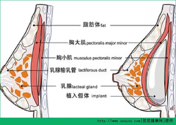 隆胸手術后可以母乳喂養(yǎng)嗎？隆胸后可以喂奶哺乳嗎？(2)