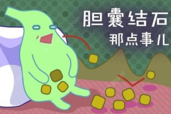 哪些人最容易得膽結(jié)石？膽結(jié)石有哪些明顯特征？(1)