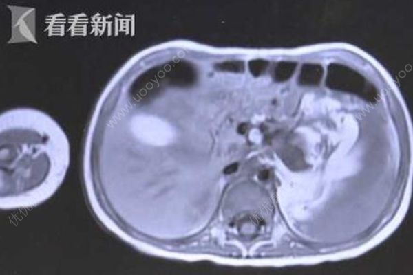 3歲女童腹腔長(zhǎng)直徑約15厘米腫瘤，嬰寶寶腫瘤如何早發(fā)現(xiàn)？(2)