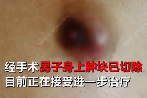 六旬老翁患上女人??！醫(yī)生說乳腺癌非女性專利！(4)