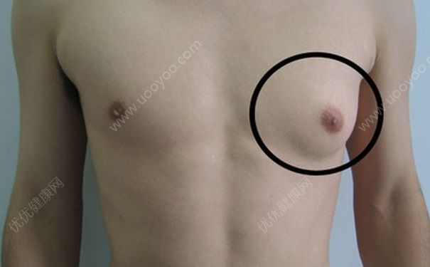 男生會(huì)得乳腺癌嗎？男生得乳腺癌的癥狀(1)