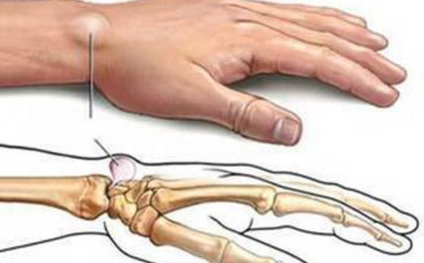 手腕起了一個(gè)鼓包怎么回事？手腕鼓包是什么原因？(1)