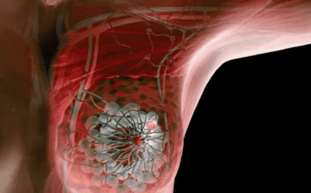 乳腺癌的早期信號是什么？誘發(fā)乳腺疾病的原因是什么？(1)