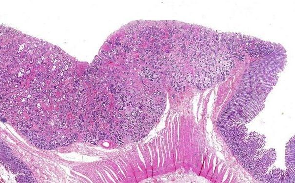 直腸癌有哪些病因？直腸癌有何治療方法？(3)