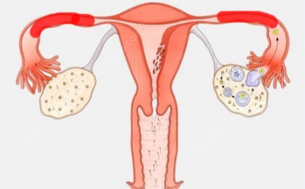輸卵管堵塞還能排卵嗎？輸卵管堵塞怎么辦？(2)