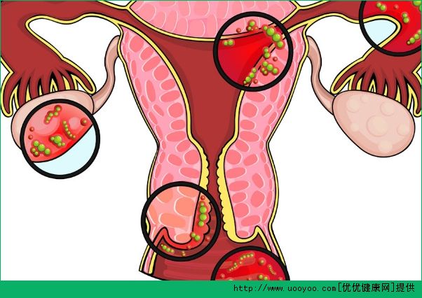 婦科病有哪些？常見的婦科病有哪些？(3)