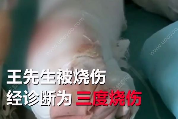 不慎引燃酒精桶，男子家中吃燒烤吃成三度燒傷(1)