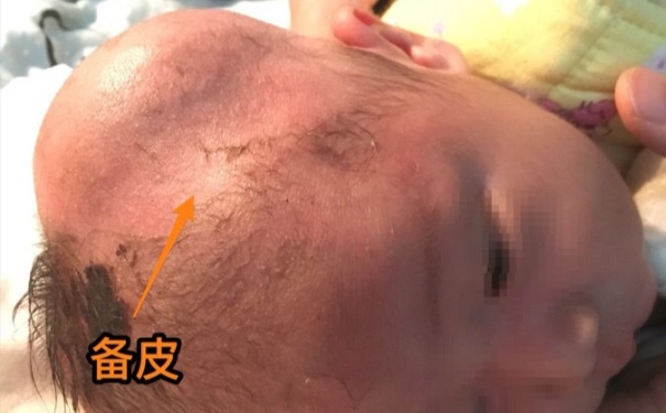 嬰兒腦血腫有后遺癥嗎？嬰兒腦血腫該怎么辦？(1)