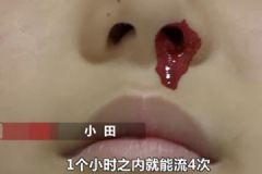 一學(xué)習(xí)就流鼻血！12歲男孩一天流20多次無奈休學(xué)！[多圖]