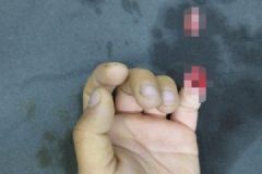 6歲男孩被夾斷手指，罪魁禍首竟是校服，手指斷了如何急救？[多圖]