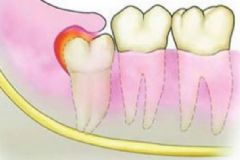 智齒發(fā)炎應(yīng)該怎么辦？智齒很疼該不該拔掉？[多圖]
