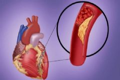 動(dòng)脈硬化有何癥狀？動(dòng)脈硬化如何診斷？[圖]