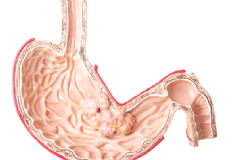 哪些習(xí)慣容易患胃癌？哪些人容易患胃癌？[圖]