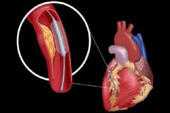 心臟病人要如何護(hù)理？心臟病有哪些危害？[圖]
