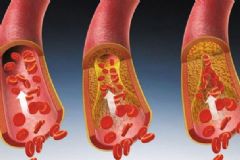 如何清除血管內(nèi)垃圾？血管有垃圾有何危害？[圖]