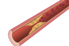 吃哪些食物預(yù)防動(dòng)脈硬化？預(yù)防動(dòng)脈硬化有哪些有效方法？[圖]