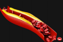 如何預防血管堵塞？怎么樣預防血管堵塞？[圖]