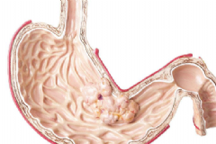 胃癌早期的癥狀有哪些？如何及時(shí)發(fā)現(xiàn)胃癌征兆？[圖]