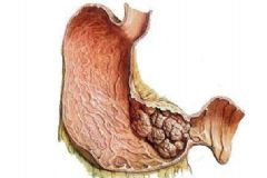 胃癌早期能治好嗎？胃癌早期有那些癥狀？[圖]