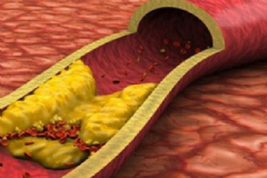 高血脂有哪些危害？怎樣降低血脂？[圖]