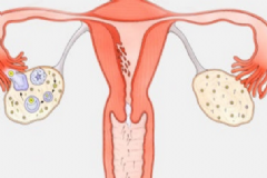 卵巢切除后怎么保養(yǎng)好？卵巢切除后怎么保養(yǎng)？[圖]