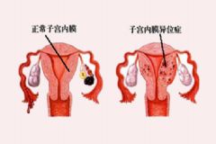 子宮內(nèi)膜異位癥能自然懷孕嗎？子宮內(nèi)膜異位癥為什么影響懷孕？[圖]