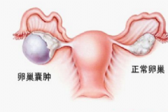 卵巢腫瘤嚴(yán)重嗎？卵巢腫瘤手術(shù)[圖]