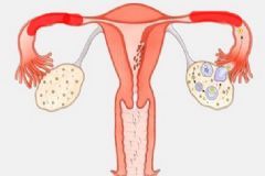 輸卵管堵塞還能排卵嗎？輸卵管堵塞怎么辦？[多圖]
