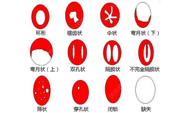 女人處女膜長在哪兒？女人處女膜是在什么位置？(1)