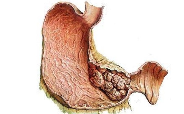 胃癌早期能治好嗎？胃癌早期有那些癥狀？(1)