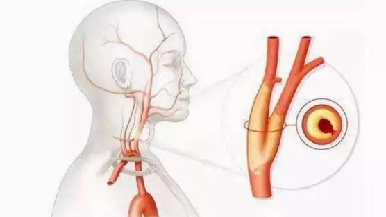血管狹窄是什么意思？血管狹窄可以恢復嗎？