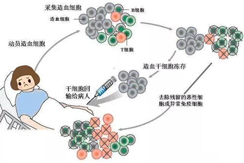 濟(jì)南血液病醫(yī)院：治療淋巴瘤自體造血干細(xì)胞移植效果咋樣？