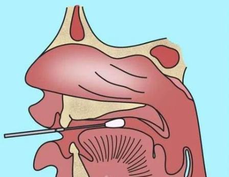 核酸檢測新冠病毒的常用手段：口腔拭子、鼻腔拭子檢測圖示