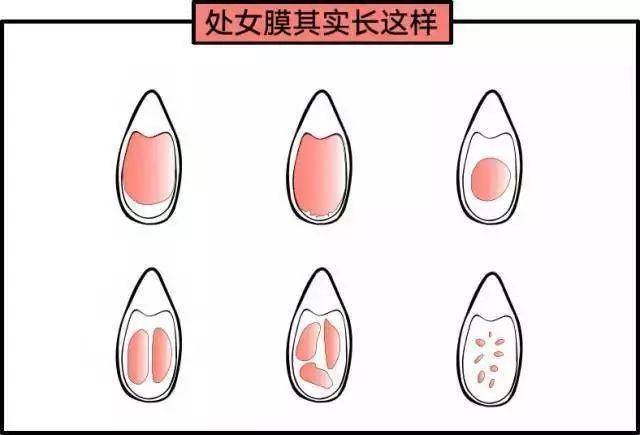 14歲女孩處女膜長什么樣？14歲女孩有處女膜嗎？[圖]