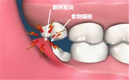 牙菌斑以及食物殘渣等容易對拔智齒的創(chuàng)口造成感染。