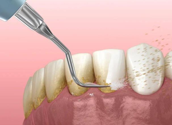 牙結(jié)石一次能完全洗干凈嗎？不想洗牙怎么去牙結(jié)石