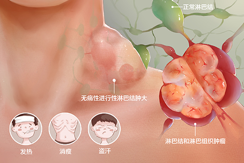 濟(jì)南血液病醫(yī)院科普：確診淋巴瘤該如何治療？自體移植效果好嗎？