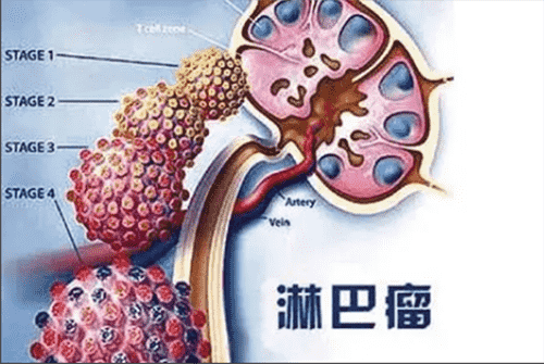 濟南血液病醫(yī)院科普：治療非霍奇金淋巴瘤，化療、移植哪個好？