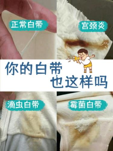 白帶各種癥狀圖片大全