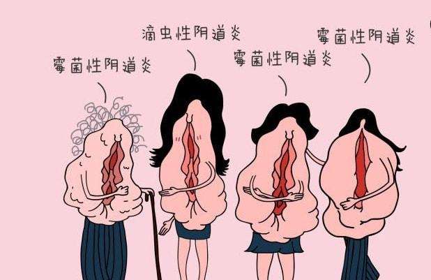 女性在生活中怎樣預(yù)防女性私處炎癥？女性私處炎反復(fù)發(fā)作原因[圖]